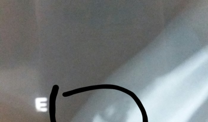 Cirurgia  fratura por avulsão