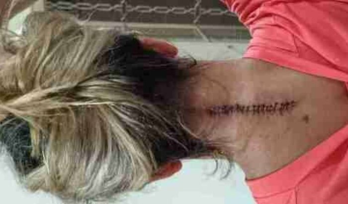 Cura da Tainara - Tumor na Medula Cervical