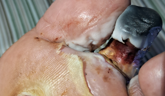 Tratamento do Márcio 