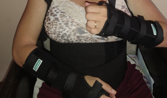 Tratamento médico , CID M06.4 - Poliatropatia inflamatória, M79.7 - fibromialgia, G56.0 Síndrome do túnel do carpo