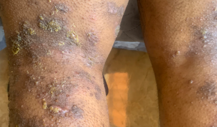 Dermatite atópica gravíssima - Doença auto imune