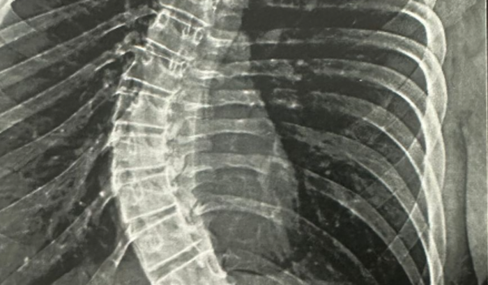 Cirurgia Escoliose da Karol