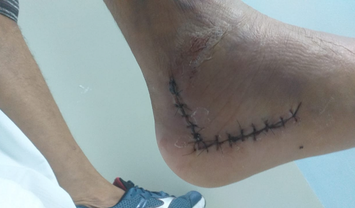 Vilmondes - Acidente de Trabalho - Pedreiro Autônomo 