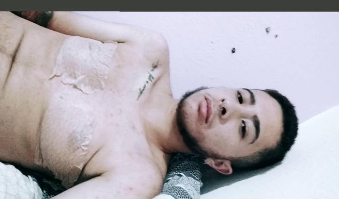 CIRURGIA mamoplastia masculinizadora