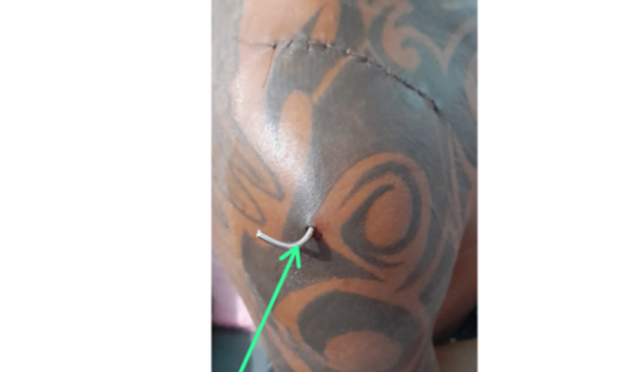 Cirurgia após lesão em jogo de futebol