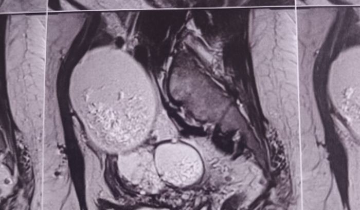 Cirurgia de Histerectomia e Salpingooforectomia para a Maria