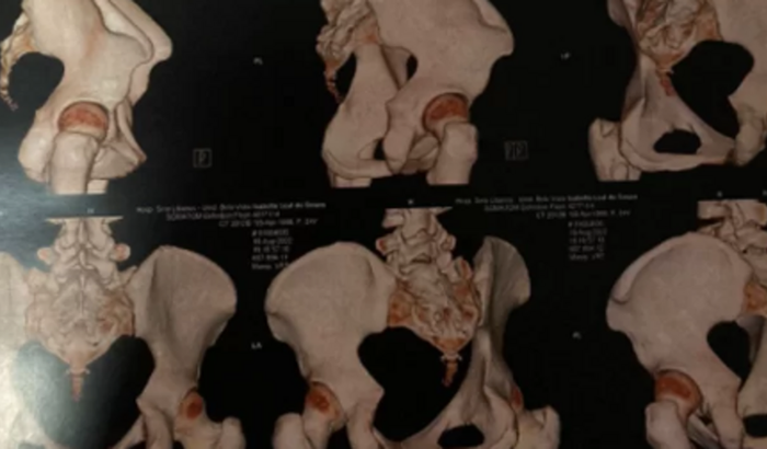 Ajuda para o Tratamento da Flocos