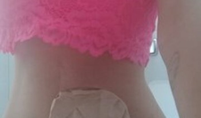 Ajudar para uma pessoa com bolsa de colostomia 