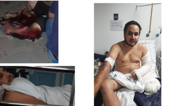 Ajuda para Pedro Recuperar a Mobilidade: Contribua para a Prótese Transfemural