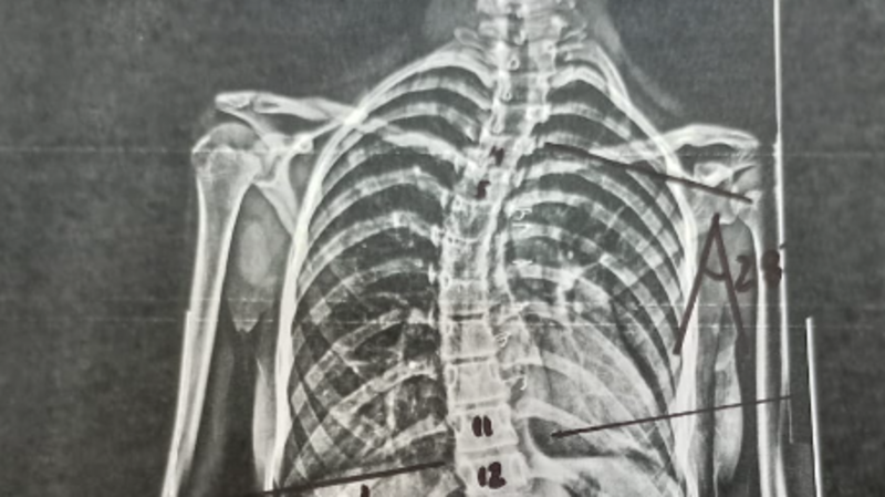 imagem da vaquinha Ajude Sofia 12 a comprar Colete 3D para Escoliose Idiopática