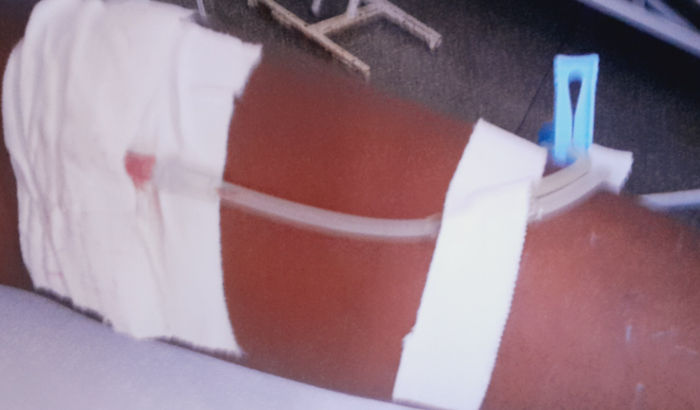 Doença pedra na vesícula organismo tudo enflamado