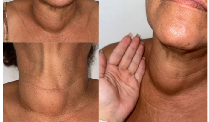 Cirurgia da Preta: Terapia Ablativa de Nódulo da Tireóide