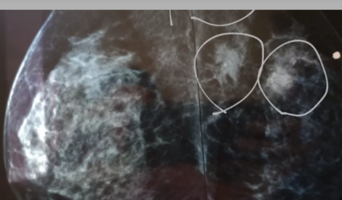 Ajude a vida cancer de mama estagio 3