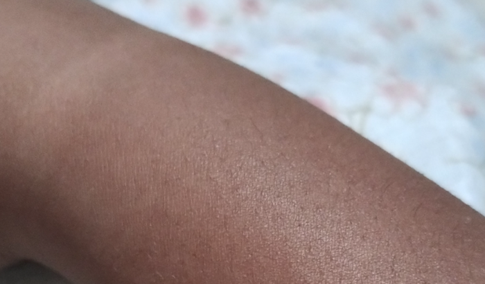 Tratamento do antebraço - Me ajude para que eu possa comprar o remédio!