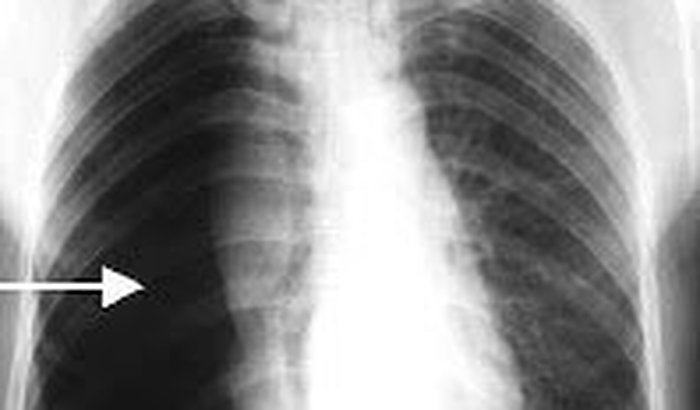 Pneumotórax Espontâneo