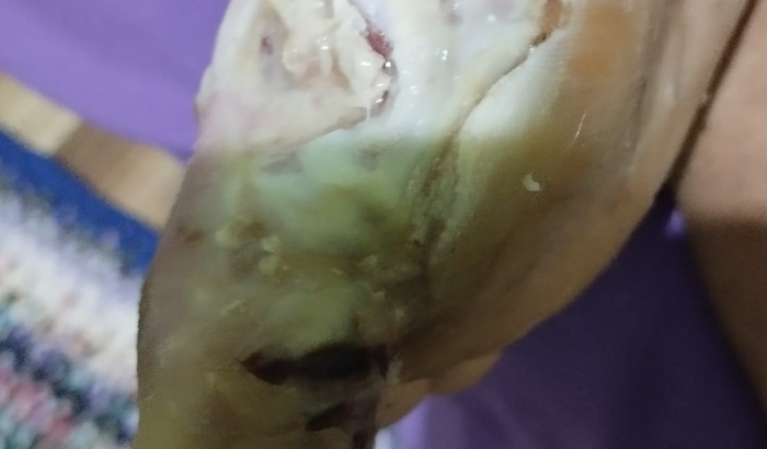 Ajude com a cirurgia para amputação do pé diabético do meu pai