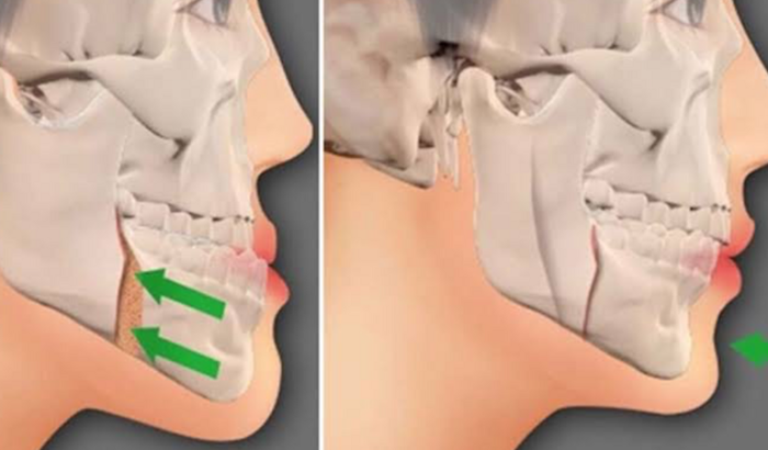 Preciso fazer uma cirurgia ortognatica, para aliviar minhas dores da face e trazer minha autoestima. 