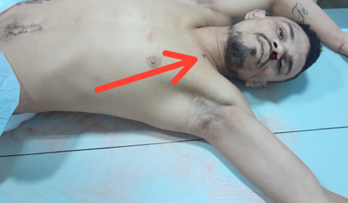 Preciso porque tenho uma fratura na bacia não posso trabalhar dói muito quando faz forças 