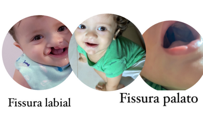 Cirurgia Palato Thomas 