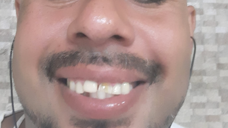 Arrumar  meus dente