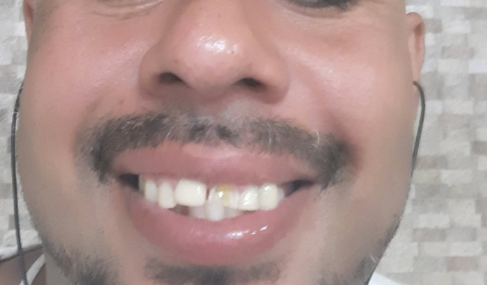 Arrumar  meus dente