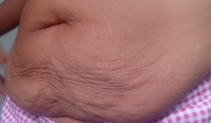 AJUDA PÓS CIRURGIA BARIÁTRICA 