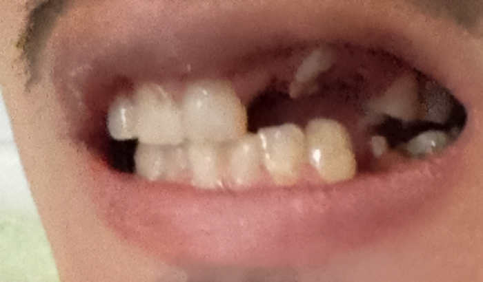 Arruma meus dentes, devido um problema de saúde bocal perdi alguns dentes. Tenho a vontade de arruma meus dentes 🙏 