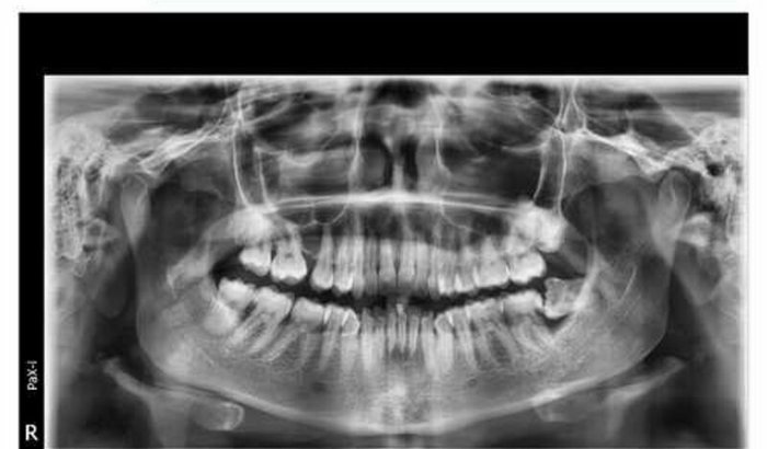 Siso dente 