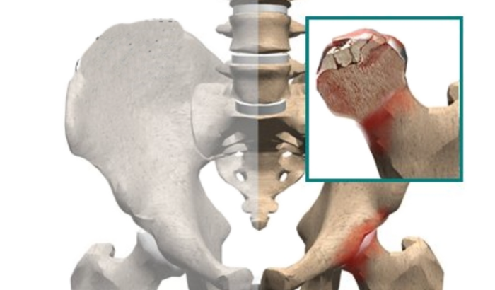 Cirurgia de prótese de quadril 