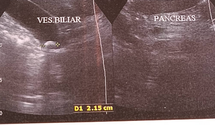 Cirurgia de vesícula 