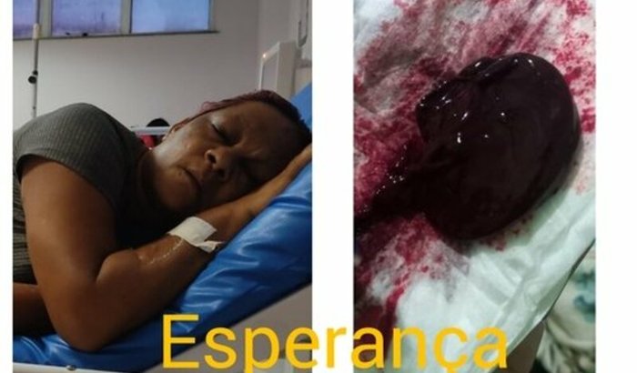 Ajuda para cirurgia de retirada de mioma 