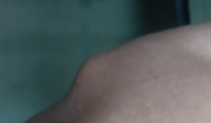 Ajuda  pra  faser  cirurgia  no  meu  ombro deslocado  muita  dor  não  consigo  mais  trabalhar