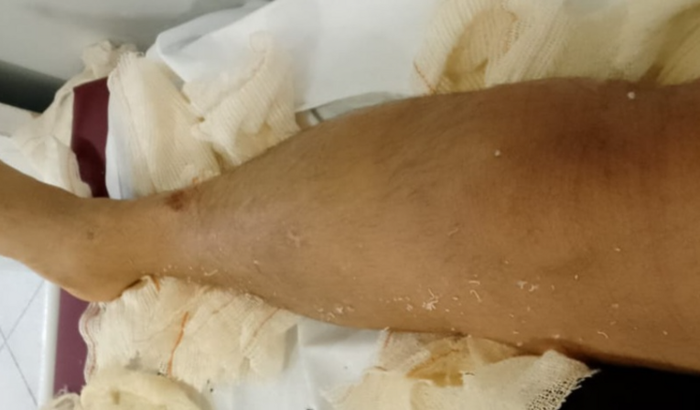 Cirurgia e platina no joelho de Jaime W. P. da Silva Júnior.