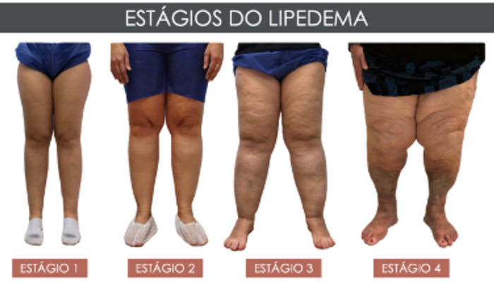 Cirurgia de Lipedema