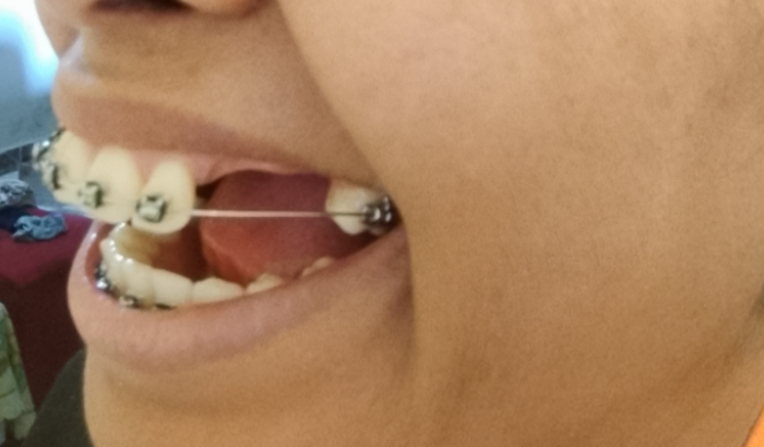 Mim ajudem tive que arrancar três dentes e está sendo muito difícil fica faltando três dentes na boca mim ajudem 