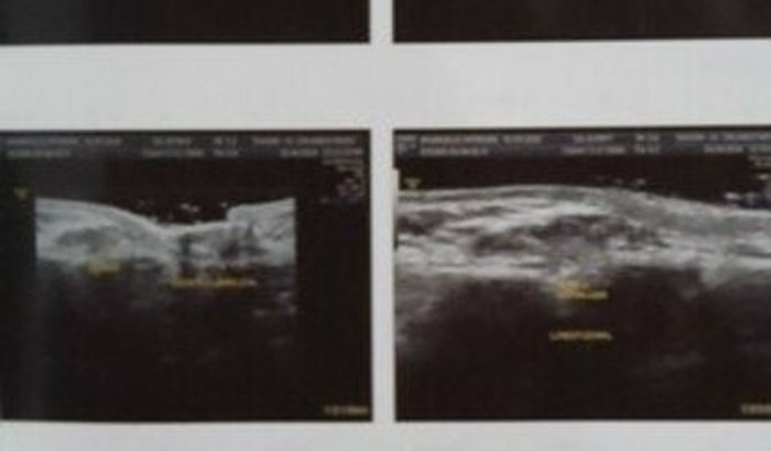 Cirurgia  da minha filha de 2 anos 