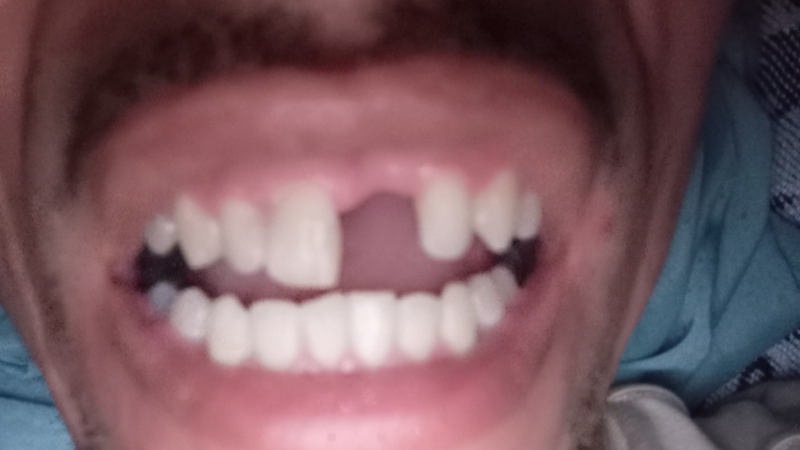 Perdi meu dente da frente não tenho condições pra colocar outro 