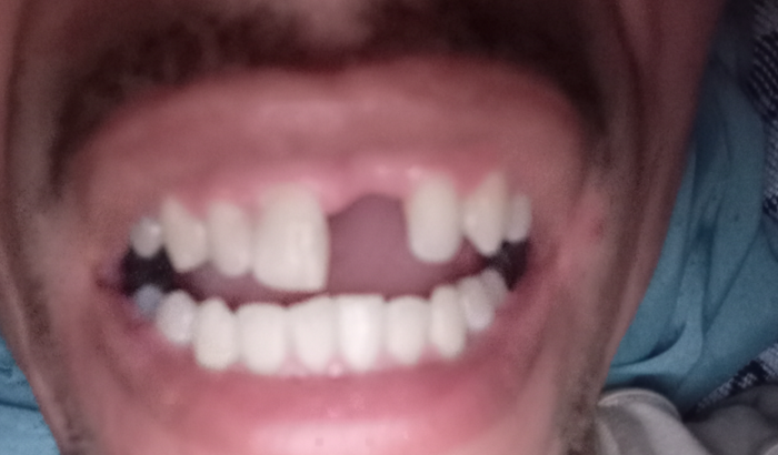 Perdi meu dente da frente não tenho condições pra colocar outro