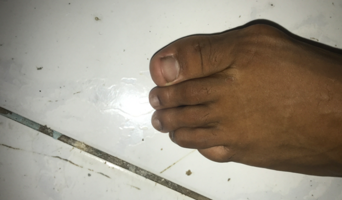 Para cirurgia de joanete 
