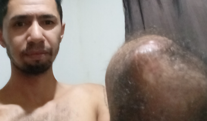 Me ajude a comprar uma prótese 