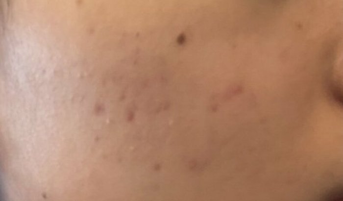 Ajudar a pagar o tratamento de acne