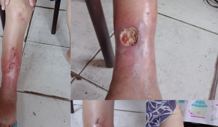 Tratamento da perna 