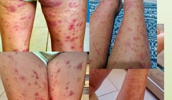 Ajudem a Manu vencer uma bactéria no sangue