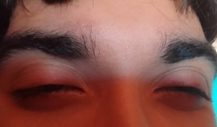 Para fazer a cirurgia nos meus olhos