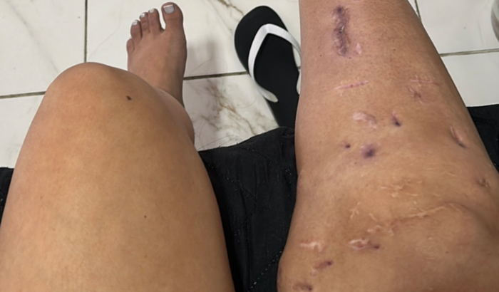 CIRURGIA NO JOELHO/ARTRODESE