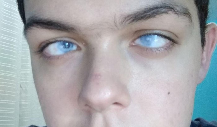 Transplante endotelial de córneas