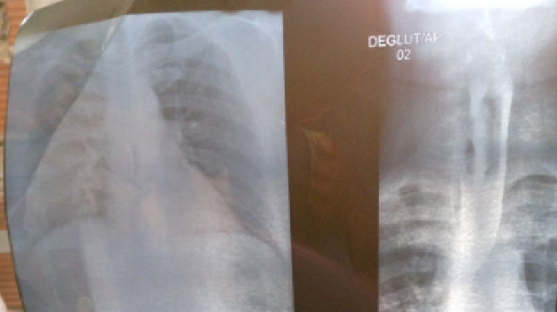 "POEM: Um Novo Horizonte para Robson"