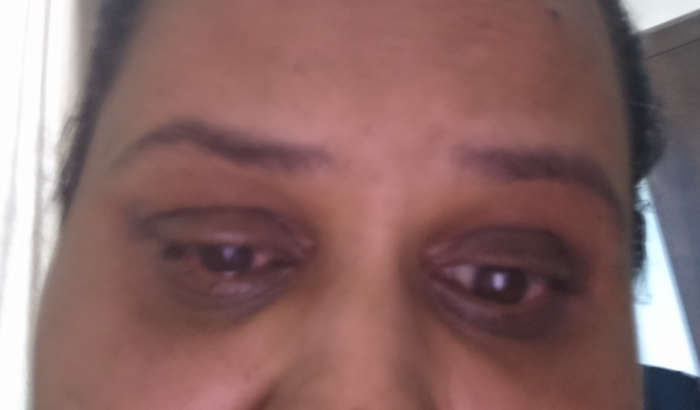 Ajuda para comprar lente escleral para ceratocone