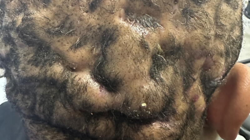 Tratamento Gutemberg ( Kunta)