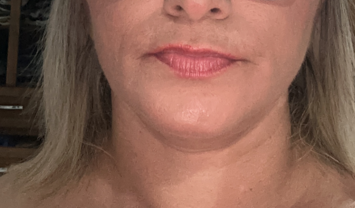 Implantes Dentários